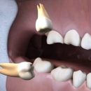 Стоматологи рассказали, что делать с зубами мудрости