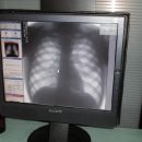 Больных туберкулезом в Украине будут лечить дома