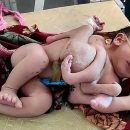 В Индии родилась девочка с четырьмя ногами и тремя руками
