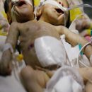 В Украине родились сиамские близнецы: с двумя головами (видео)