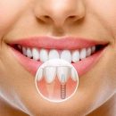 Установка зубных имплантов – проблема с которой может столкнуться каждый